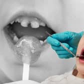 Thousands of children in England had rotten teeth removed last year (Image: Adobe/NationalWorld/Kim Mogg)
