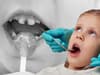 Tooth decay and deprivation: children from poorer areas of England far more likely to have rotten teeth