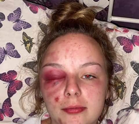 A photo which Eleanor Williams posted on Facebook, saying she had been raped and beaten by a grooming gang. However police found that she had inflicted these injuries with a hammer. Credit: Facebook