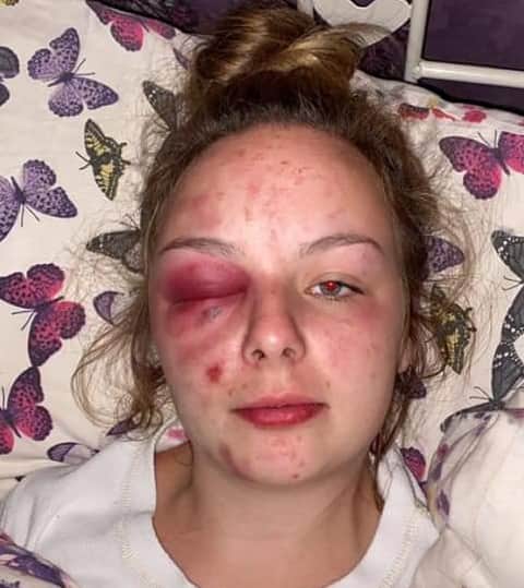A photo which Eleanor Williams posted on Facebook, saying she had been raped and beaten by a grooming gang. However police found that she had inflicted these injuries with a hammer. Credit: Facebook
