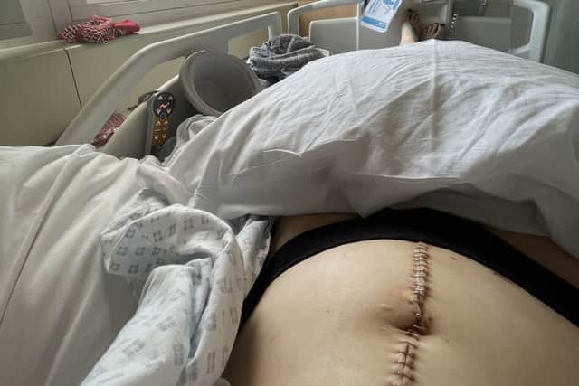 Beki Reilly shows surgical staples in stomach following emergency surgery. Picture:  Irwin Mitchell / SWNS