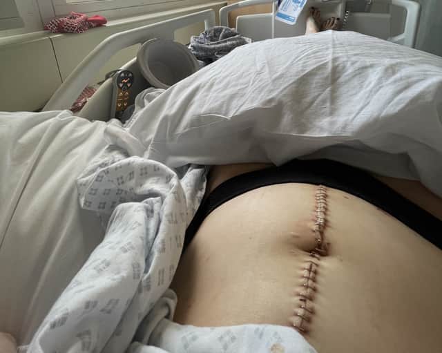 Beki Reilly shows surgical staples in stomach following emergency surgery. Picture:  Irwin Mitchell / SWNS