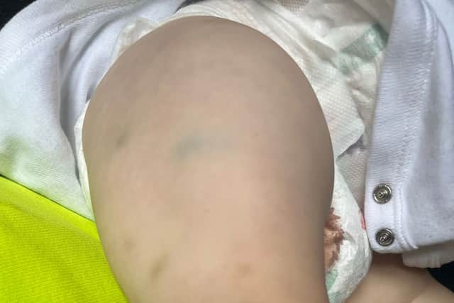Bruises on Bailey Kilbane’s legs (Photo: Beth Reilly / SWNS)