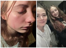Lily Butler shows her injuries suffered at the hands of school bullies (Photos: SWNS)