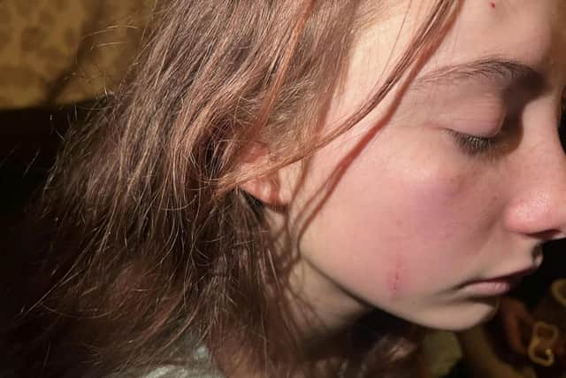 Lily Butler shows her injuries suffered at the hands of school bullies (Photo: SWNS)