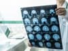 New hope for life-changing treatment to prevent Alzheimer’s disease by 2040 after gene breakthrough
