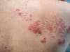 Shingles: symptoms including rash, is there a vaccine, is it contagious, what is it and treatment explained
