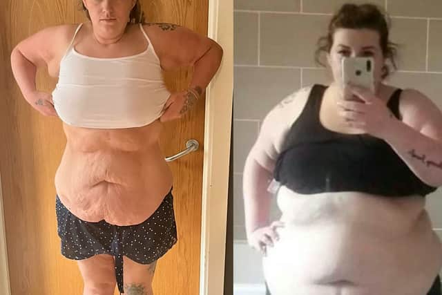 Sara was left with excess skin after losing 12 stone (Photo: Sara Platt / SWNS)