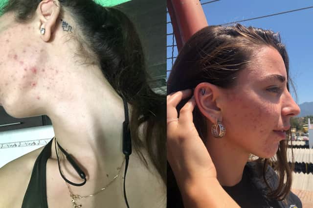 Kai-Lee Worsley says a vegan diet caused her hair to fall out and acne to break out on her skin (Photo: Kai-Lee Worsley / SWNS)