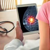 Breast cancer survival rates have improved in the UK over the past two decades (Photo: NationalWorld/Adobe Stock)