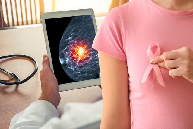 Breast cancer survival rates have improved in the UK over the past two years (Photo: NationalWorld/Adobe Stock)