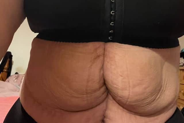 Emma’s stomach following the surgery