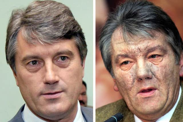 Two pictures show (L) Ukrainian opposition leader Viktor Yushchenko in Kiev 06 July 2004 and (R) 10 December 2004.  Ukrainian opposition leader and presidential hopeful Viktor Yushchenko was the victim of dioxin poisoning, his doctor in Vienna disclosed 11 December 2004 adding that he suspected foul play.