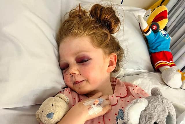Lily-Mae West, age 8, broke 15 bones in her skull and suffered a brain injury after getting hit by a zorbing ball. She is pictured in hospital after the accident. Photo by Day One Trauma Support/SWNS.