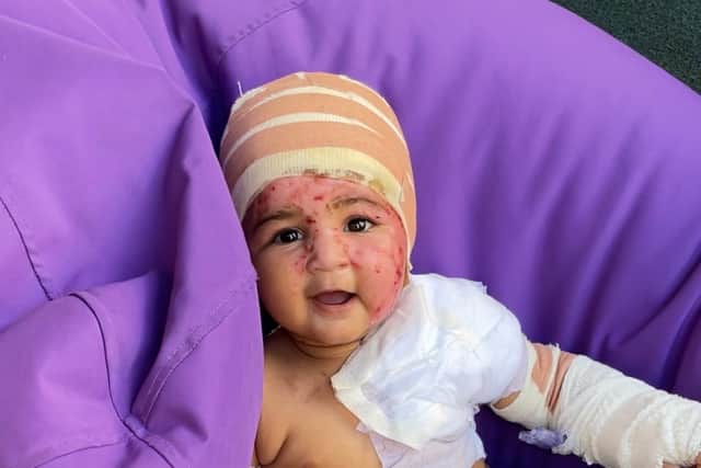 Alaya, aged just one, managed to knock the hot beverage onto her face and was sent to a burns unit for treatment - Credit: SWNS