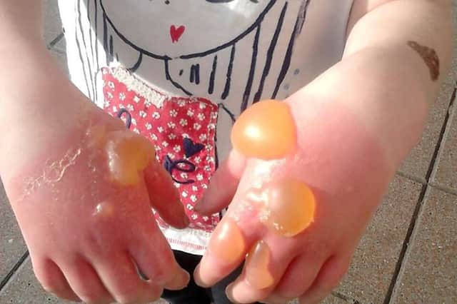 Blisters on the hands of a ten-year-old Scottish girl who came into contact with giant hogweed (Photo: SWNS)