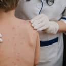 The Joint Committee on Vaccination and Immunisation has recommended that the NHS admminister the chickenpox vaccine to children aged 12 months to 18 months. (Credit: Adobe)