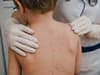 Chickenpox: infants between 12 and 18 months should be given vaccine, NHS told by JCVI committee