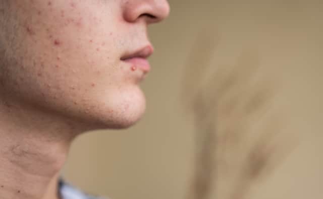 Acne can become a big problem for people during the winter months. (Picture: Adobe Stock)