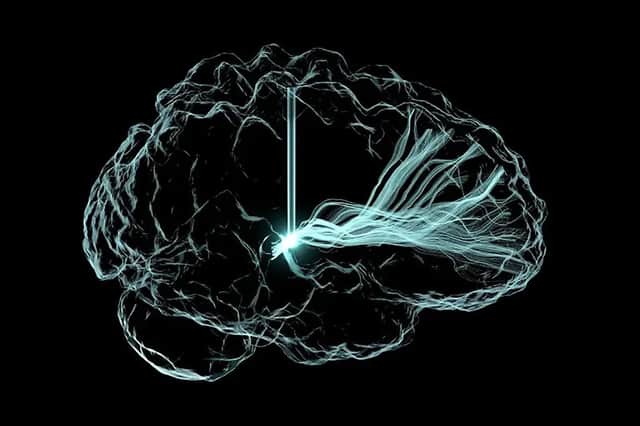A computer rendering based on scans of an actual patient who suffered a traumatic brain injury in a car accident. The electrode stimulated neurons with branches reaching far across the brain. (Image: Andrew Janson/Butson Lab)