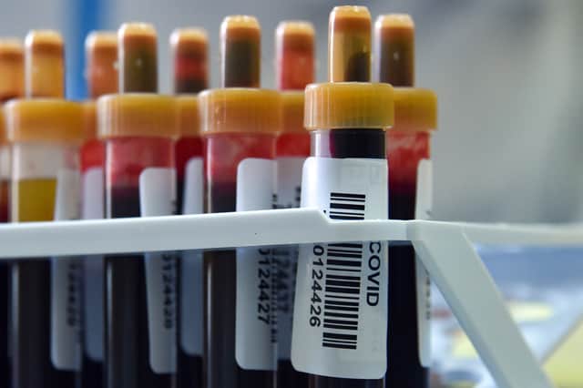 Blood samples (Image: VASILY MAXIMOV/AFP via Getty Images)