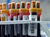 Blood tests: new revelation can tell you are ageing fast or slowly