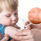 A national incident has been declared following a rise in Measles cases.