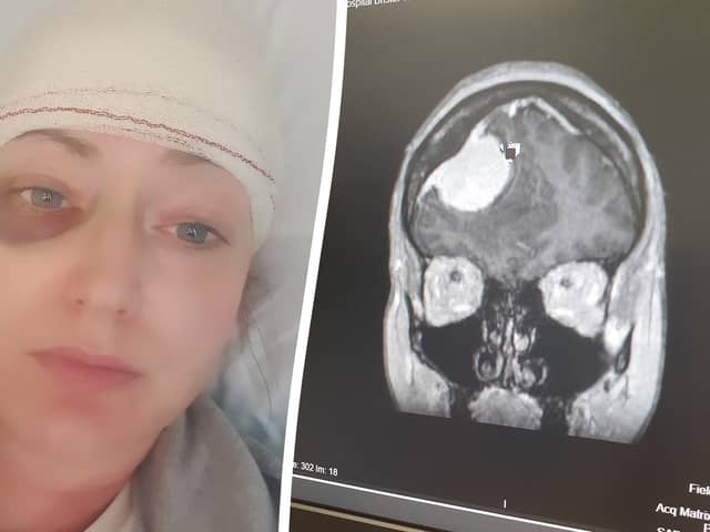 Pippa Griffiths woke up feeling numb on one side - which turned out to be a brain tumour. (Picture: SWNS)
