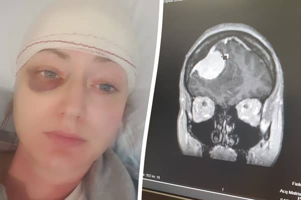 Pippa Griffiths woke up feeling numb on one side - which turned out to be a brain tumour. (Picture: SWNS)