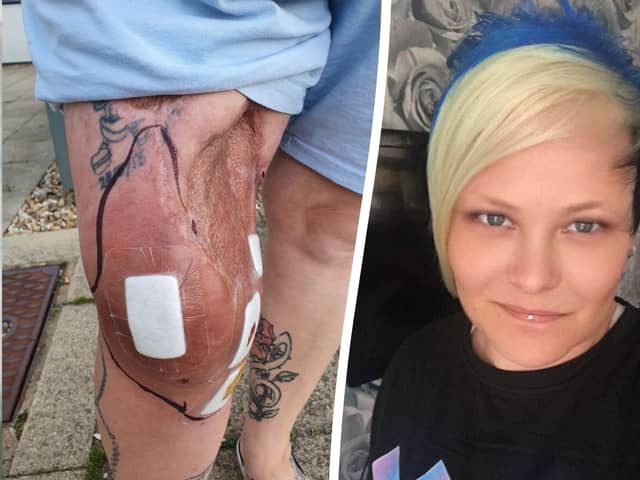 Michelle Milton, from Essex, is begging doctors for an amputation as her leg "oozes pus" every single day. (Picture: SWNS)