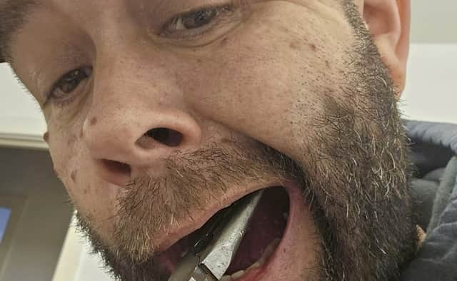Chris Langston pulled his tooth out with pliers after trying for six months to get an NHS dentist appointment. (Picture: Chris Langston/SWNS)
