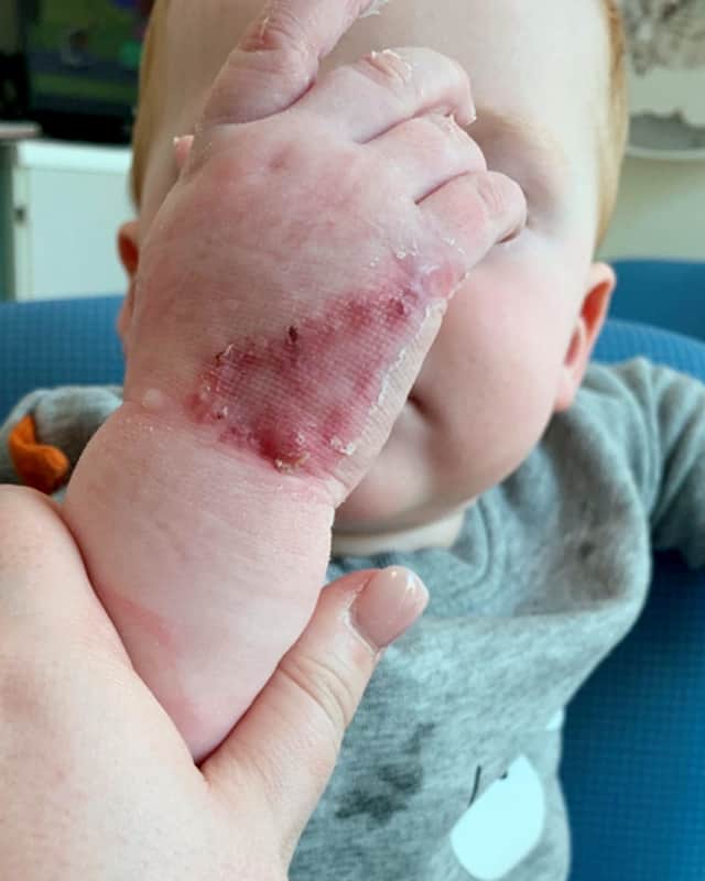 Billy getting treatment at hospital - his mum revealed how toddler was left with shocking burns - from hair straighteners. (Picture: Electrical Safety First / SWNS)