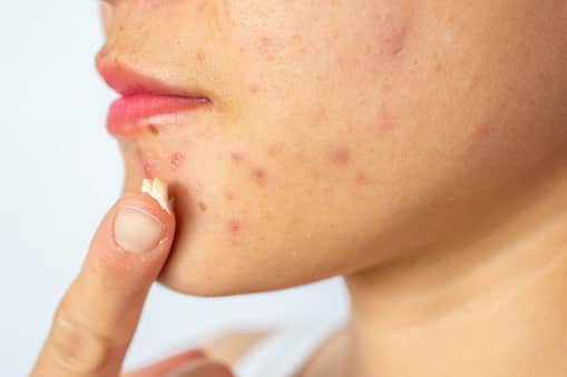Popular brands have been urged to recall their acne treatment products after high-level cancer causing chemical benzene was found 