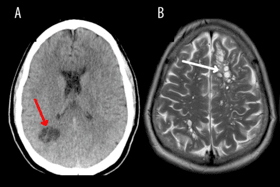 A man developed tapeworms in his brain and experienced migraines after eating under cooked bacon, according to American researchers. (Credit: American Journal of Case Reports)