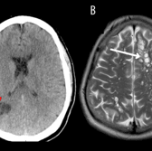 A man developed tapeworms in his brain and experienced migraines after eating under cooked bacon, according to American researchers. (Credit: American Journal of Case Reports)