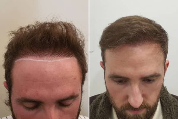 Tom Brett with the Turkey transplant, left, and after remedial work in London, right, by The Treatment Rooms