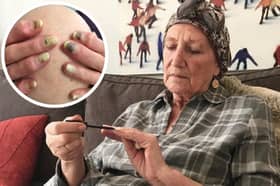 Val St.Clair from Glastonbury was the only patient on the cancer unit who still had perfect nails by the end of chemotherapy after finding out about Polybalm. Picture: Robert Thomas
