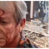 Celebrity antiques dealer Ian Towning reveals injuries after being attacked in store by two men with hammers. ian.towning/Instagram