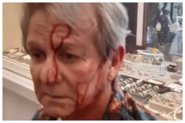 Celebrity antiques dealer Ian Towning reveals injuries after being attacked in store by two men with hammers. ian.towning/Instagram