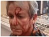 Celebrity antiques dealer Ian Towning reveals injuries after being attacked in store by two men with hammers