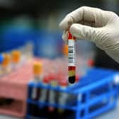 A revolutionary new blood test is set to begin trials in the UK, with the aim of helping to make early diagnosis of Azheimer's disease and dementia accessible to all. (Credit: Getty Images)