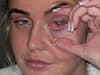 Receptionist's warning after contact lens mistake leaves her 'blinded'