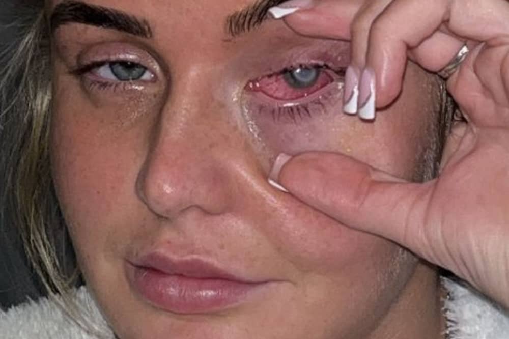 Lillie Barrett was temporarily blinded in one eye. Picture: Kennedy News & Media 
