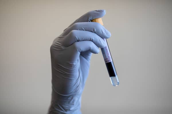 Methods of screening men for prostate cancer are set to be trialled in a bid to save thousands of lives in the UK each year. (Credit: Simon Dawson/PA Wire)