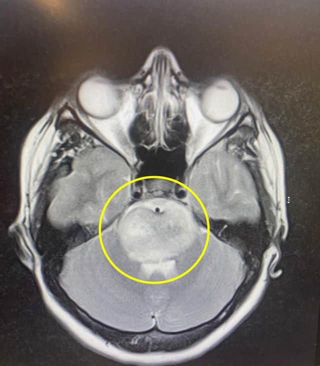 Scan of the brain tumour. Picture: Kennedy News and Media