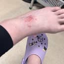 A woman has warned of a tanghulu TikTok challenge as her daughter was left with burn blisters from 'prison napalm' (Kennedy News and Media)