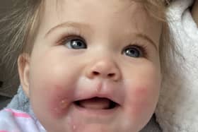 Tyler Field was shocked when her seven-month-old daughter, Imelda Sykes, developed a red rash on her face and hands after eating a celery stick in the sun. Picture: Kennedy News and Media