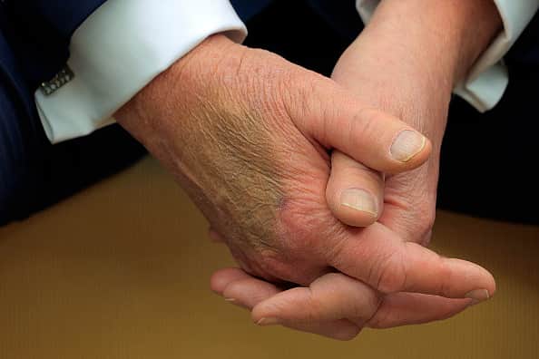 A large bruise has been spotted on the back of Donald Trump’s hand, sparking speculation about his health.
