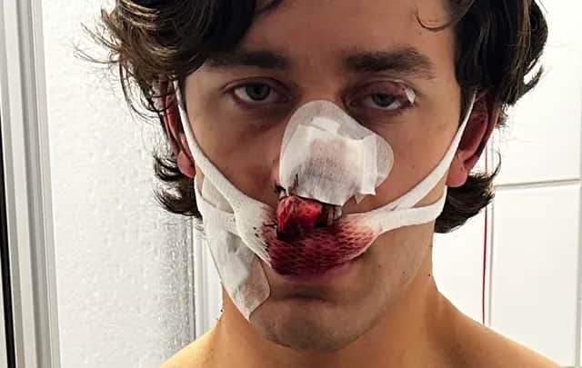 A heroic American tourist and model was reportedly stabbed in the face by an illegal migrant in Germany while protecting two women being harassed on a tram. (Photo: GoFundMe)