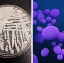 Cases of candida auris are rising across the world, with the infectious fungus becoming resistant to drug treatment. 